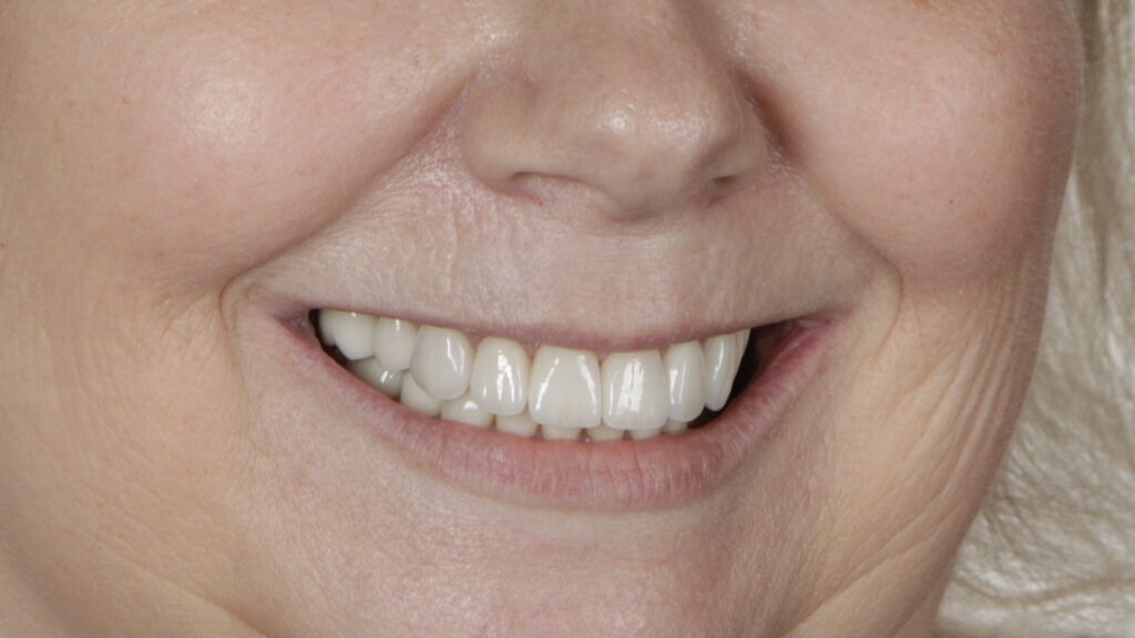 Patient smile after treatment