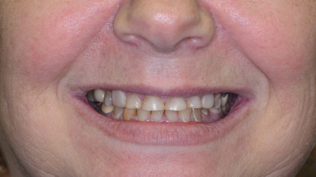Patient smile before treatment